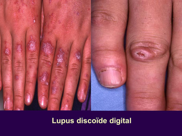 Les signes déterminant la présence lupus de dans l’organisme